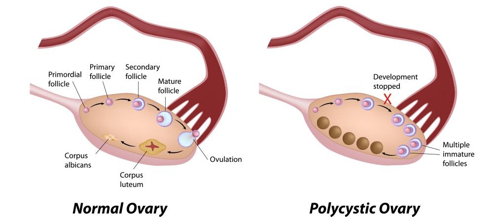 Diagram comparing a normal ovary with a polycystic ovary