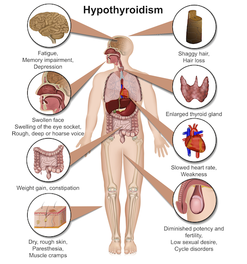 Image describing the effects of hypothyroidism on the body